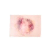 MT003 Femur Fracture Closed