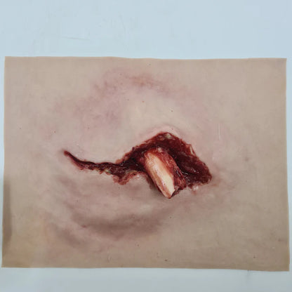 MT002 Protruding Femur Fracture image 1