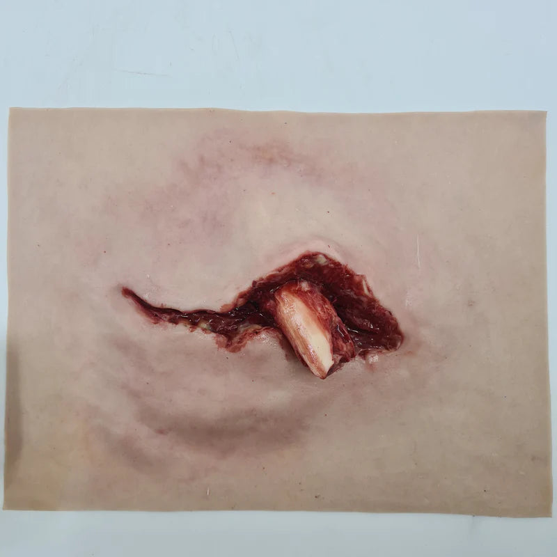 MT002 Protruding Femur Fracture image 0