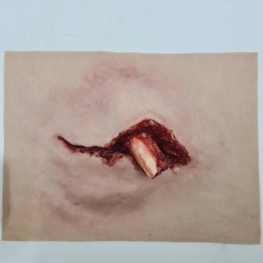 MT002 Protruding Femur Fracture image 0