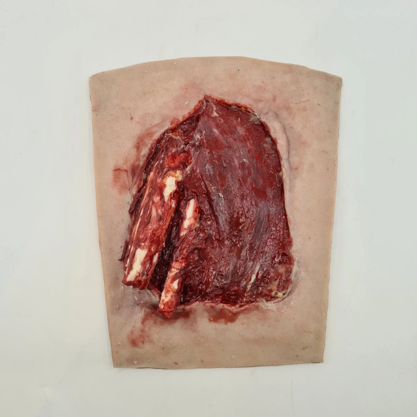 MT008 Tib Fib fracture image 1