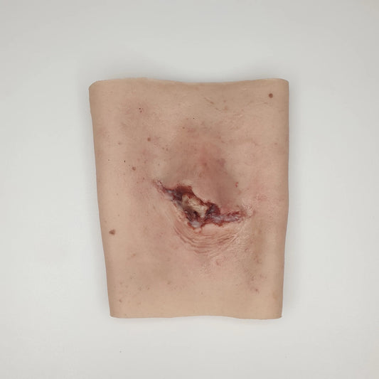 MT006 Open Tibia Fracture image 1