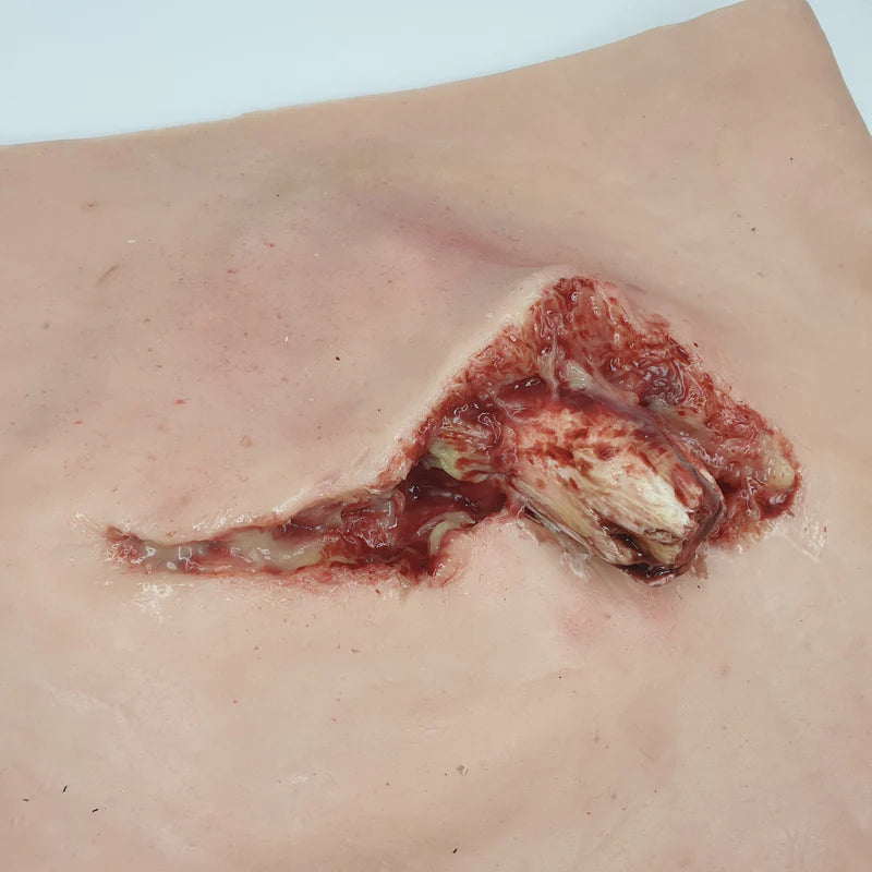MT002 Protruding Femur Fracture image 2