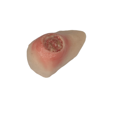 MW431 Bedsore On Heel