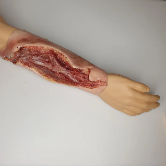 MB130 Electrical Burn Lower Arm image 1