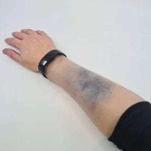 Bruise sleeves