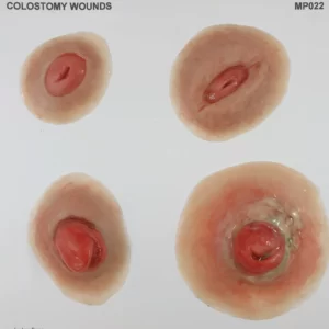 Colostomy Wound Care