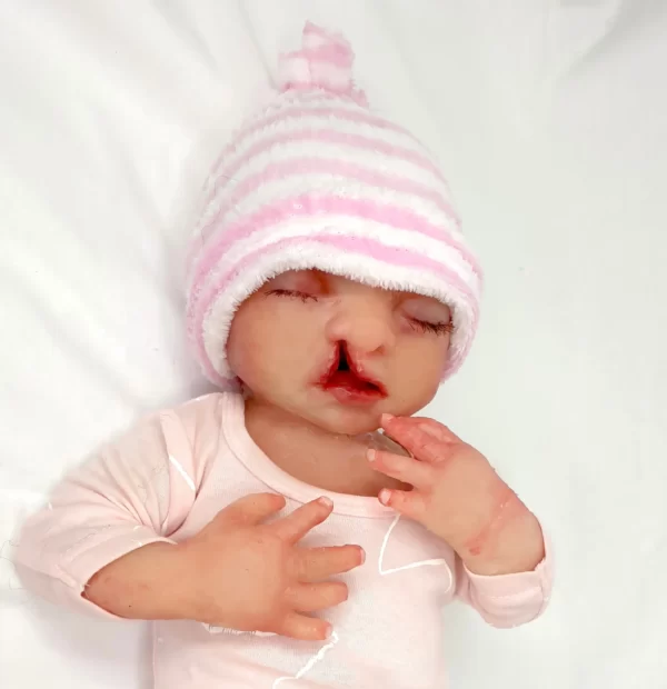 MO822 Baby Natasja with cleft lip