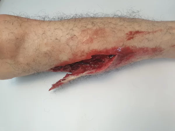 Trauma wound packing lower leg